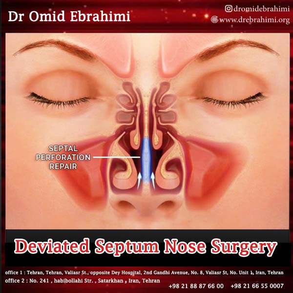 Deviated Septum Nose Surgery Nose Surgery Dr Omid Ebrahimi